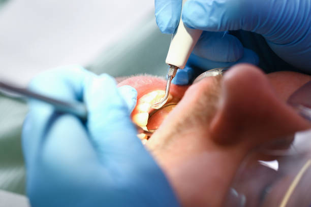 Best Urgent Care for Lost Fillings or Crowns in Penn Valley, CA